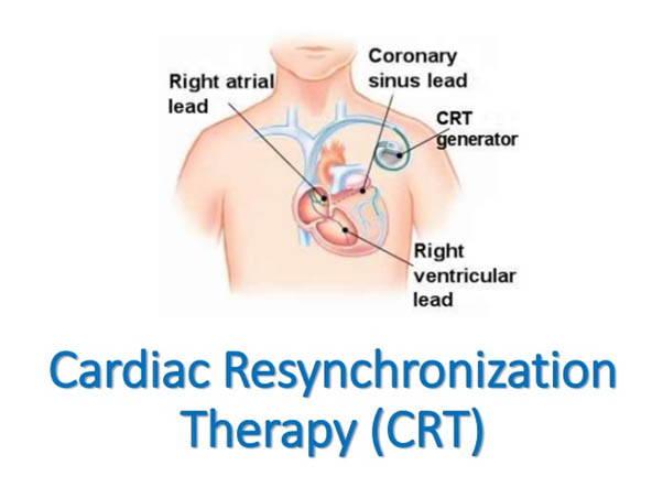 cardiac resynchronization therapy