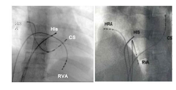 Cardiac Electrophysiologist Near Me