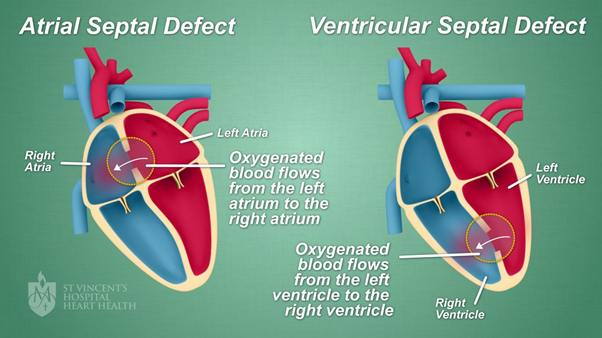 Device Closure Procedure, ASD, VSD, PDA