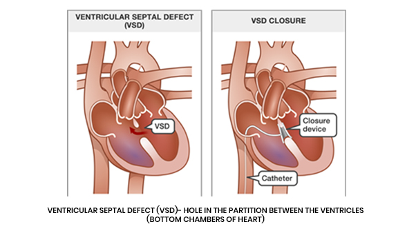 Device Closure Procedure, ASD, VSD, PDA