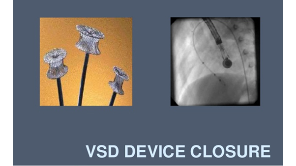 Device Closure Procedure, ASD, VSD, PDA