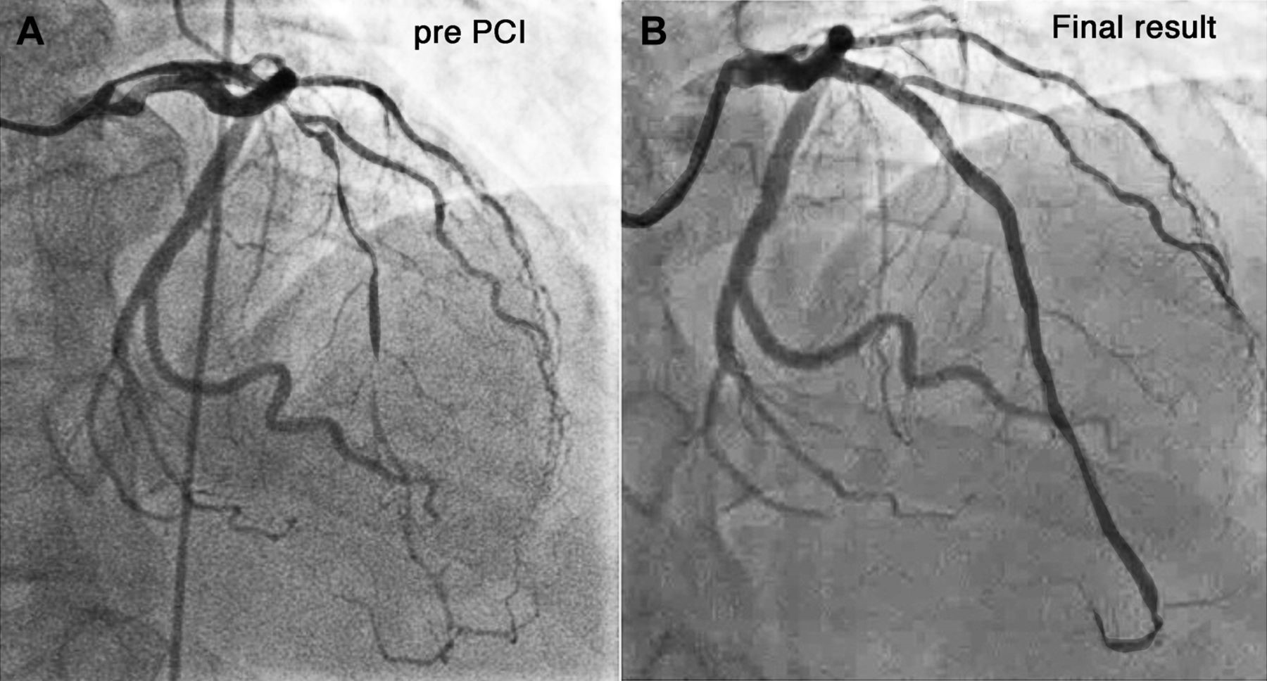 Angioplasty Specialist Near Me