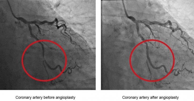 Angioplasty Specialist Near Me