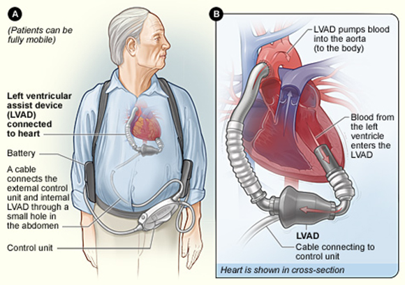 Heart transplant specialist in Bangalore
