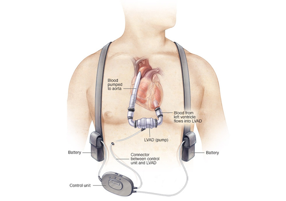 Heart transplant specialist in Bangalore