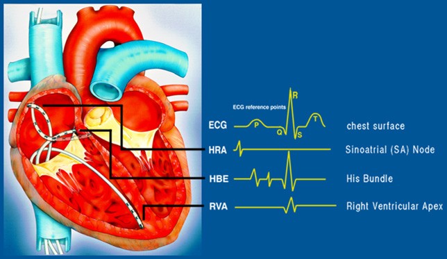 cardiac electrophysiology